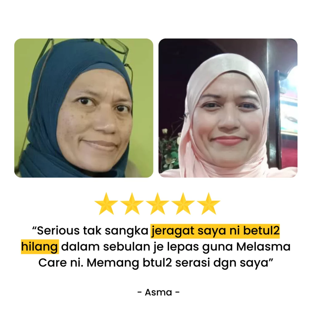 TESTIMONI PENGGUNA YANG DAH BERJAYA HILANGKAN JERAGAT DENGAN MELASMA CARE