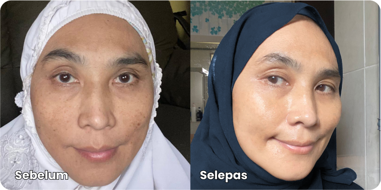 TESTIMONI PENGGUNA YANG DAH BERJAYA HILANGKAN JERAGAT DENGAN MELASMA CARE