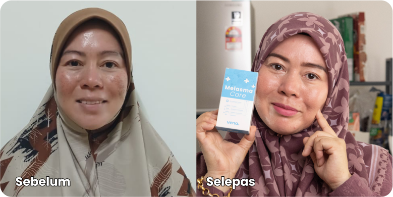 TESTIMONI PENGGUNA YANG DAH BERJAYA HILANGKAN JERAGAT DENGAN MELASMA CARE