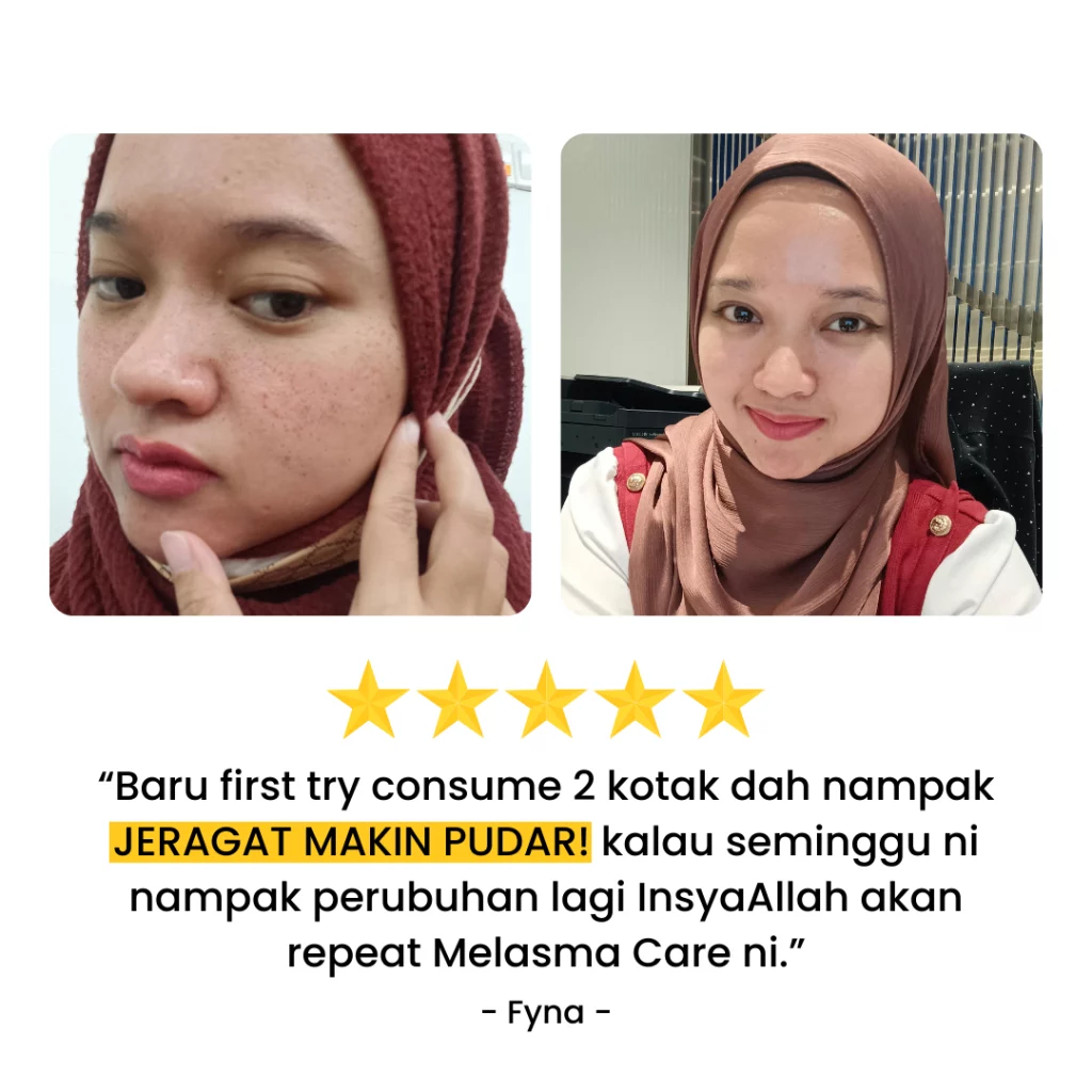 TESTIMONI PENGGUNA YANG DAH BERJAYA HILANGKAN JERAGAT DENGAN MELASMA CARE