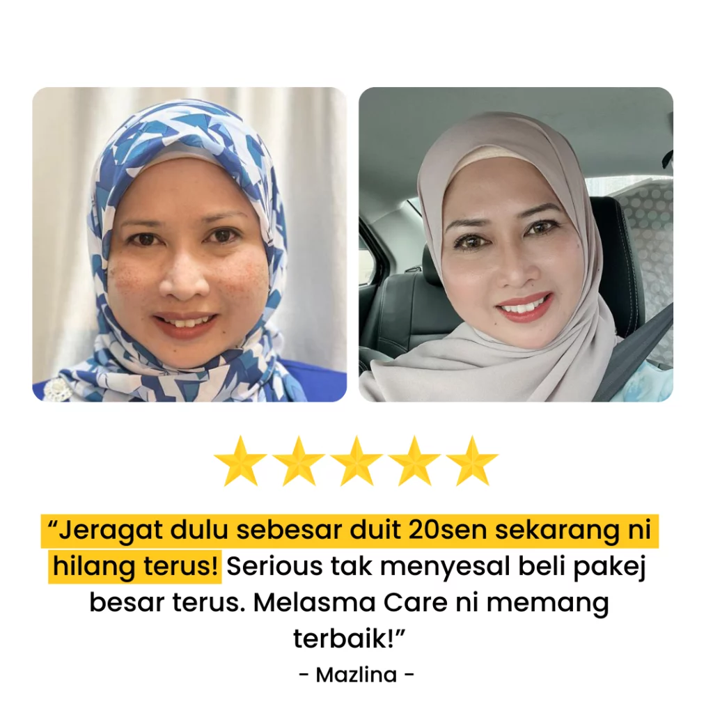 TESTIMONI PENGGUNA YANG DAH BERJAYA HILANGKAN JERAGAT DENGAN MELASMA CARE